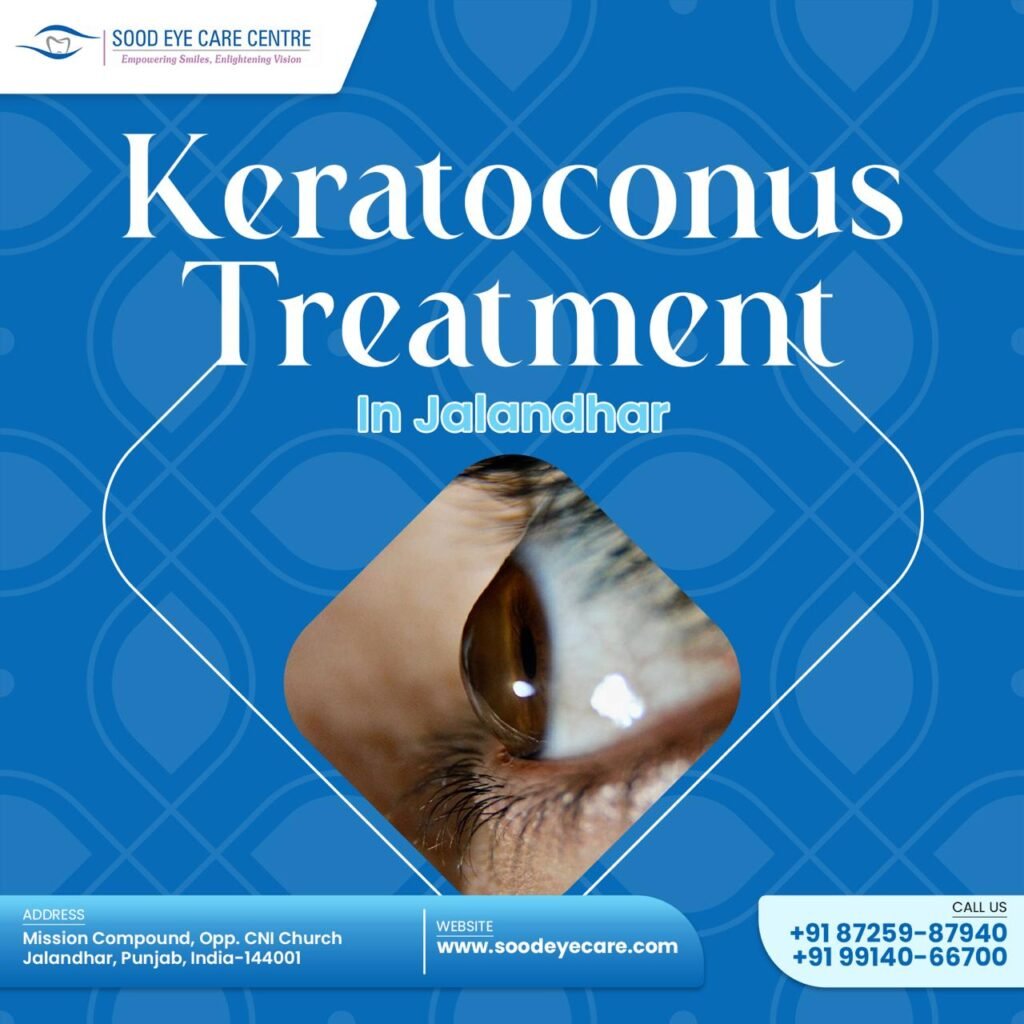 Sood Eye Care Center in Jalandhar offers comprehensive treatment for keratoconus, including specialized contact lenses, cross-linking procedures to strengthen the cornea, and corneal transplants for advanced cases. With a team of experienced specialists and advanced technology, the center ensures personalized care for improved vision and eye health.